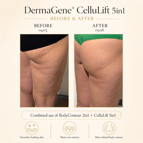 DermaGene® Total Body Sculpt & Smooth 360° System