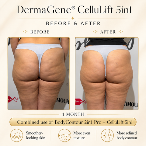 DermaGene® Total Body Sculpt & Smooth 360° System