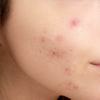 Acne