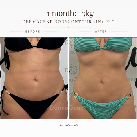 BodyContour PRO 2in1 – Home Fat Reduction & Body Firming Device with Cavitation & Radiofrequency