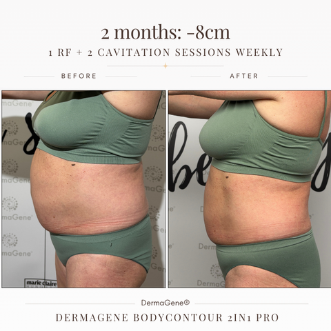 BodyContour PRO 2in1 – Home Fat Reduction & Body Firming Device with Cavitation & Radiofrequency