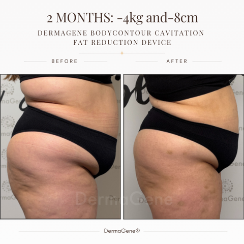 DermaGene® Total Body Sculpt & Smooth 360° System