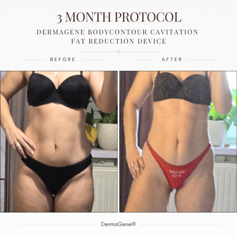 DermaGene® Total Body Sculpt & Smooth 360° System