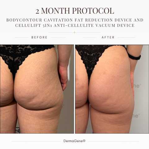 DermaGene® Total Body Sculpt & Smooth 360° System